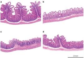 Image result for Radiation Colitis