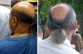 Ponytail Balding Hair
