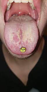 Tongue Piercing Help Its Day 12 Is This A Bad Sign I Started Just Washing My Mouth Twice A Day And Its Been This Way Getting Worse I Guess I Dont Know Im