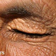 Image result for xantelasma