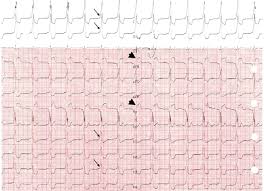 No heart murmur was found. References In Fast Broad And Irregular Wolff Parkinson White Syndrome The American Journal Of Medicine