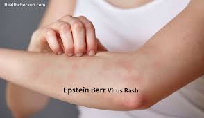 See full list on dermnetnz.org Epstein Varr Virus Rash Definition Symptoms Causes Treatment Pictures