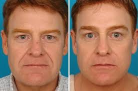 You can easily determine whether a celebrity has botox or not. Brow Lift Salt Lake City Brow Lift Park City Brow Lift Surgery Utah