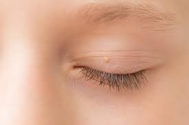 Image result for milium cyst on eyelid