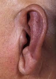 Relapsing Polychondritis Wikipedia