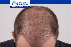 After any hair transplantation that is performed using choi implanter pens the healing is rapid. Hair Transplant Stages Hair Transplant Growth Chart Iranian Surgery