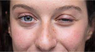 Myasthenia gravis is an autoimmune disease which results in muscle fatigability and weakness throughout the day. Ø£Ø¹Ø±Ø§Ø¶ Ø§Ù„ÙˆÙ‡Ù† Ø§Ù„Ø¹Ø¶Ù„ÙŠ ÙˆØ·Ø±Ù‚ ØªØ´Ø®ÙŠØµÙ‡ ÙˆÙŠØ¨ Ø·Ø¨