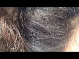 Bird Mites In Hair Head Lice Infestation Dad Reacts To Crawling Bugs In Kids Hair A Parents Nightmare Youtube Hair Lice Kids Hairstyles Head Lice Infestation