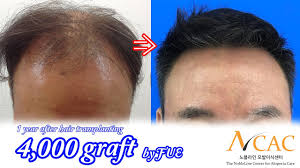 Hair transplant in india hair transplant surgery best hair transplant vancouver hair clinic how to grow eyebrows male pattern baldness hair regrowth hair hair transplant mind blowing results. Fue Hair Transplant For Asian Nobleline Asian Hair Transplant Clinic Youtube