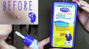 Wart remover can cause a rare but serious allergic reaction or severe skin irritation. Dr Scholls Dual Action Freeze Away Common Planter Wart Remover Kit Demo Review Youtube