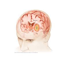 Lung cancer symptoms also resemble those of many other conditions, making it hard to discern the cause. Mayo Clinic Dr Joon Uhm A Mayo Clinic Neuro Oncologist And Brain Tumor Specialist Describes Symptoms Diagnosis And Treatment Of Brain Tumors Learn More About Brain Tumor Care At Mayo Clinic Https Mayocl In 2gzn4cd