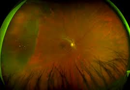 But, diseases such as macular degeneration, glaucoma, retinal tears or detachments, and other health problems such as diabetes and high blood pressure can be seen with a thorough exam of the retina. Retinal Detachment Recognizing Pathology Optos