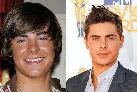 The internet doesn't know how to deal with the new version of zac efron. Zac Efron Chin Iimplant Nose Job Plastic Surgery Before And After Celebie Zac Efron Plastic Surgery Celebrity Plastic Surgery Plastic Surgery