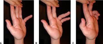 Finger flexors fds and fdp Variations Of The Flexor Digitorum Superficialis As Determined By An Expanded Clinical Examination Journal Of Hand Surgery