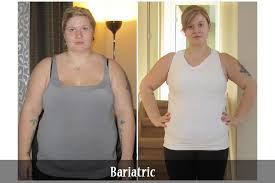 Pin On Bariatric Surgery