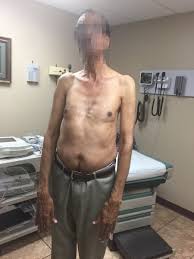 Usually first noticed in the early teen years. The Patient Had Marked Pectus Excavatum A Classic Sign Of Marfan Syndrome Download Scientific Diagram