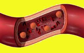 Thrombosis occurs when a thrombus, or blood clot, develops in a blood vessel and reduces the flow. Thrombosis Vena Mesenterika
