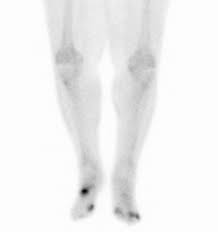Image result for Osteomyelitis Bone Scan
