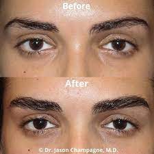 I finally decided that getting a brow transplant was the solution for me. Everything You Need To Know About Eyebrow Transplants Spa And Beauty Today
