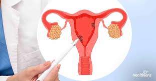 Cervical cancer affects the entrance to the uterus. Cervical Cancer Causes Symptoms Treatment Prevention