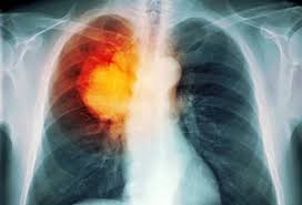 Image result for lung cancer xray
