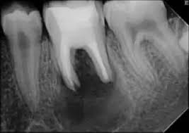 Image result for granuloma gum disease