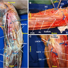 Vein carrying deoxygenated blood from the upper body (above the diaphragm) back to the right main artery of the upper limb passing through the clavicle and extending through the axillary. Right Upper Limb Dissection Photographs Showing The Origin And Path Of Download Scientific Diagram