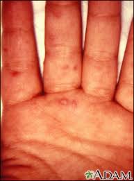 Image result for Hand foot and mouth disease HFMD roof of mouth