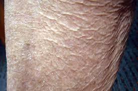 Image result for Eczema nummulare
