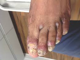 dystrophic toenails