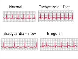 Bradycardia and tachycardia are two forms of irregular heart rates, or arrhythmias. Electrical Processes Of The Heart Online Presentation