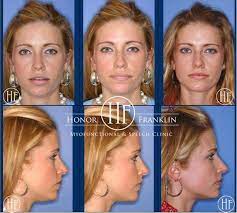 Claimingpower Orofacial Myofunctional Orofacial Myofunctional Therapy Myofunctional Therapy