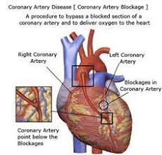 Coronary Artery Disease Rosh Review Coronary Arteries Coronary Artery Disease Coronary