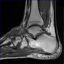 Mri of the soft tissues of the foot visualizes the fat cushions of the sole, heels, fingers and can show swelling, foci of infiltration and inflammation. Mri Lower Extremities Leg Cedars Sinai