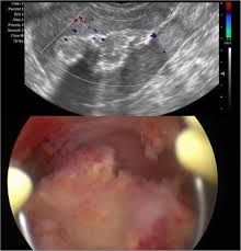 Image result for Retained Placenta