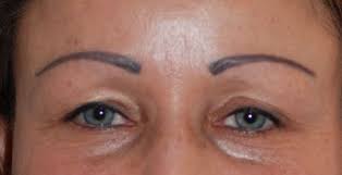 Jetzt begreift auch sie selbst, dass da irgendetwas falsch gelaufen war. Augenbrauentransplantation Haartransplantation Tv Reportagen