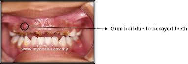 Gum Boil In Children Portal Myhealth