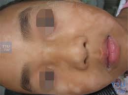 Pityriasis alba is a common condition in practice mostly occurring in children between the ages of 3 and 16, but can be additionally seen in young adults. å›¾ ç™½è‰²ç³ ç–¹ Pityriasis Alba çš„ç—‡çŠ¶è¡¨çŽ° çš®è‚¤ç—…è¯Šæ–­å›¾è°± å¤©å±±åŒ»å­¦é™¢