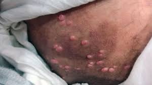 Image result for skin rash acute hiv infection