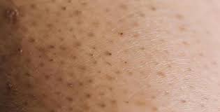 They're easily irritated, hard to get rid of, and can cause unwanted skin discoloration and bumps. What Causes Ingrown Leg Hairs And How To Prevent Them
