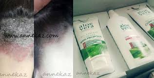 Sedef Ve Egzama Tedavisi Pictures Sedef Ve Egzama Tedavisi Images Sedef Ve Egzama Tedavisi On Pinstake Com Aloe Vera Aloe Vera