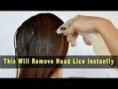 Home Remedies To Get Rid Of Lice Fast