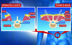 3.3 șurub cu cap hexagonal. Operatia Care Costa De 20 De Ori Mai Putin In Romania Decat In Statele Unite Procedura Presupune Doua Implanturi In Vertebre Stirileprotv Ro