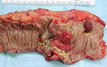 And in patients with blood cancers such as leukemia, lymphoma or multiple myeloma, the immune system may not function. Adenocarcinoma Wikipedia