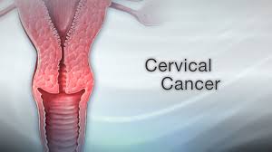 The doctor may start by asking about your personal and family medical history and do a physical exam. Cold Knife Cone Biopsy Information Mount Sinai New York