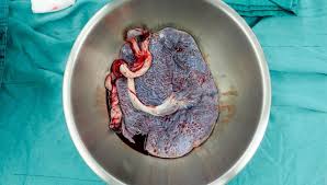 Retained Placenta American Pregnancy Association