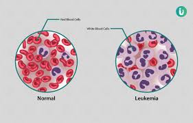 Exposure to heavy factory smoke and chemicals, formaldehyde etc., can also lead to blood cancer. Blood Cancer Symptoms Causes Treatment Medicine Prevention Diagnosis