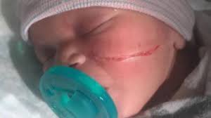 Check spelling or type a new query. Us Baby Needs 13 Stitches After Emergency C Section Leaves Her With Cut Across Check Verve Times