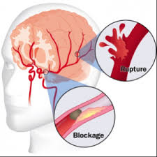 5 cause of death and a leading cause of disability in the united states. Stroke Symptoms Prevention And Clinics Mcgovern Medical School