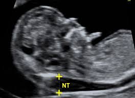 Nt focuses on a small, clear space at the back of a growing baby's neck called the nuchal fold. Nuchal Translucency Scan Fmf Certification Welcome To The Fetal Medicine Foundation